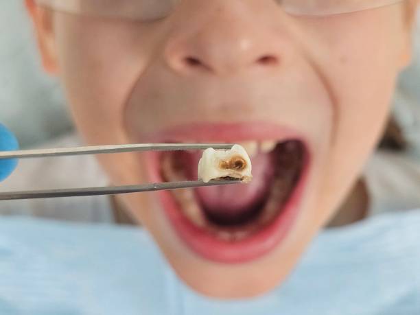 Best Tooth Infection Emergency Dentist  in Lmdale, PA